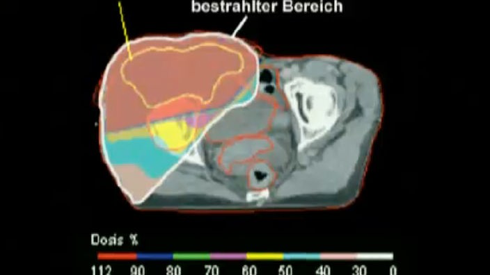 Abbildung zeigt den bestrahlten Bereich eines Gehirnes.
