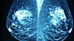 Mammografie-Röntgenbild