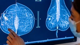 Mammografieaufnahme einer Brust