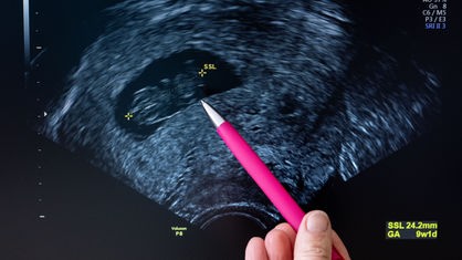 Abtreibung Symbolbild Ultraschall