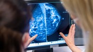 Medizinisches Personal untersucht mit einer Mammographie die Brust einer Frau auf Brustkrebs. Symbolbild 