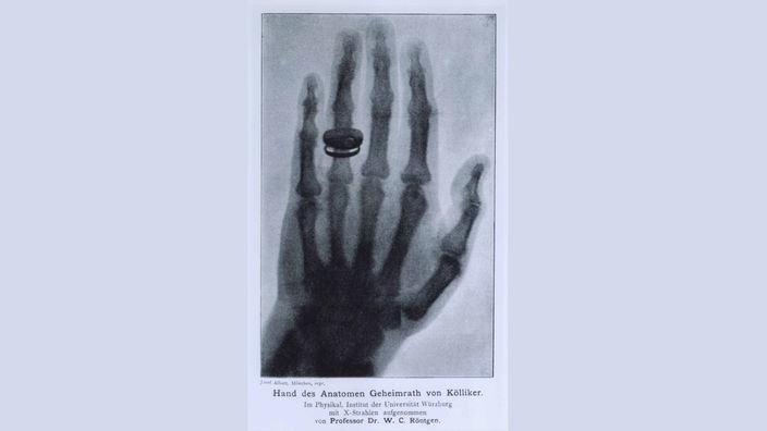 Röntgenaufnahme der Hand von Albert von Kölliker 