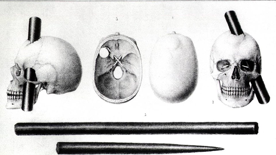 Zeichnung Eisenstange im Schädel