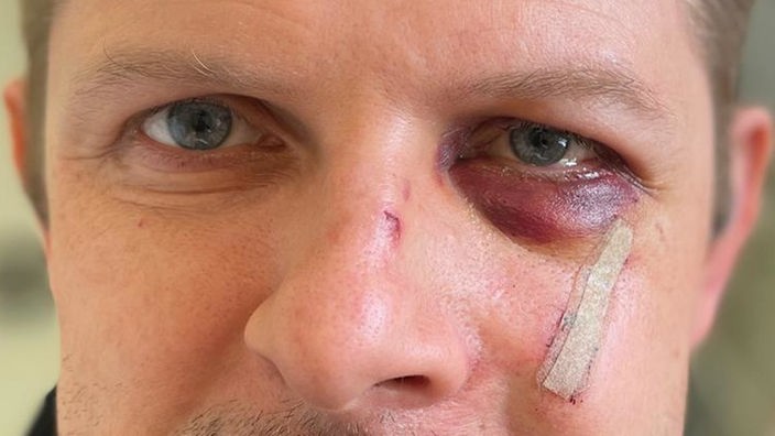 Nahaufnahme des Gesichts von SPD-Politiker Matthias Ecke, nachdem er tätlich angegriffen und schwer verletzt wurde.