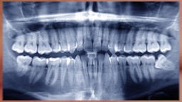 Das Bild zeigt eine Röntgenaufnahme eines Gebiss. 
