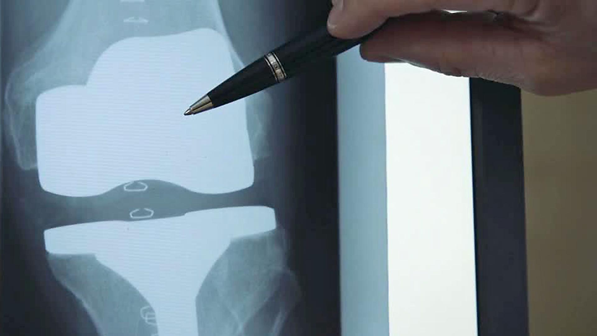 Röntgenaufnahme einer Knieprothese