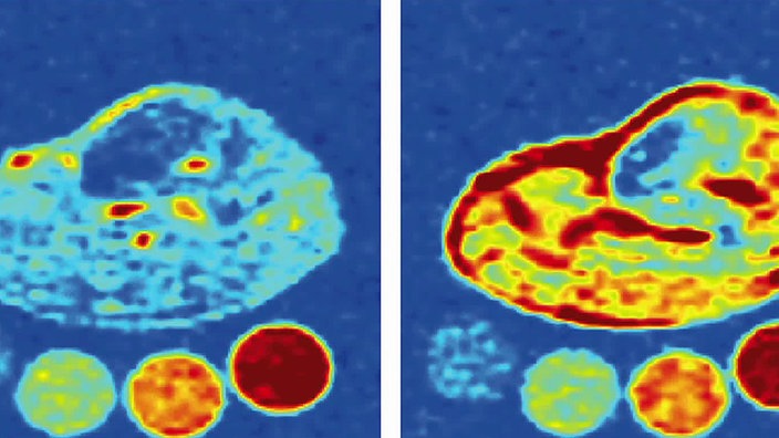 Computergrafik: Salzablagerungen im Bein