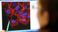 Eine Doktorandin schaut auf ein Monitorbild von Melanom-Zellen (schwarzer Hautkrebs).