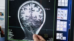 Zu sehen ist eine Hand die mit einem Stift auf einen Gehirnscan zeigt.