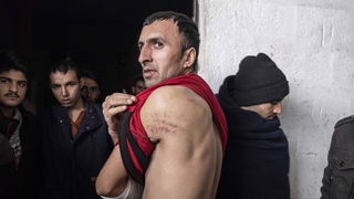 Izbeglica u Bihaću pokazuje tragove udaraca koje mu je, kako tvrdi, nanela hrvatska policija