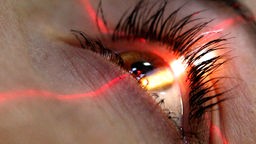 Laser-OP am Auge