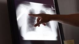 Eine Hand zeigt auf eine Röntgenaufnahme