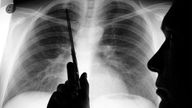 Ein Arzt ist im Anschnitt vor der Röntgenaufnahme einer Lunge zu sehen, mit einer Schere zeigt er auf kranke Stellen des Organs