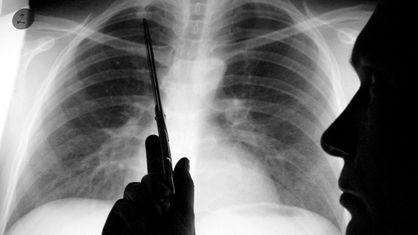 Ein Arzt ist im Anschnitt vor der Röntgenaufnahme einer Lunge zu sehen, mit einer Schere zeigt er auf kranke Stellen des Organs