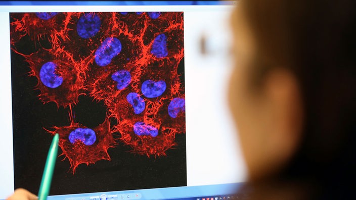 Im Labor des Instituts für Experimentelle Gentherapie und Tumorforschung (IEGT) der Universitätsmedizin Rostock schaut eine Doktorandin am 22.10.2013 auf ein Monitorbild von Melanom-Zellen (schwarzer Hautkrebs)