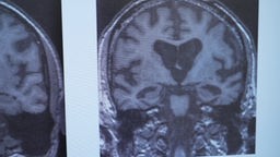 Das Bild zeigt eine MRT-Aufnahme eines Gehirns.