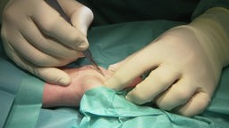 Das Bild zeigt eine Hand, die operiert wird.