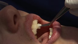 Eine Nahaufnahme eines Mundes, in dem Gerade Bleichmittel auf die Zähne getupft wird