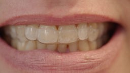 Eine Nahaufnahme von Zähnen, die von einer durchsichtigen Schiene umschlossen sind