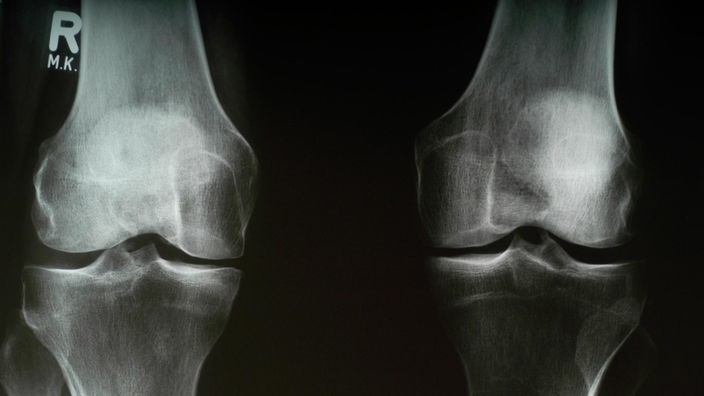 Arthrose: Röntgenaufnahme eines Knies
