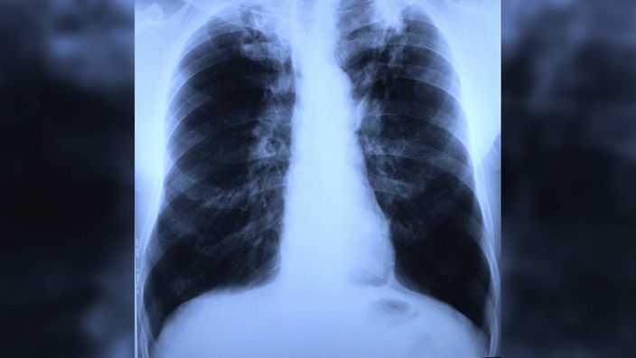 Röntgenbild von Lunge und Brustkorb mit Tuberkulosebefall